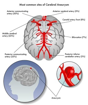 Cerebral Aneurysm Repair by Clipping by OrangeCountySurgeons
